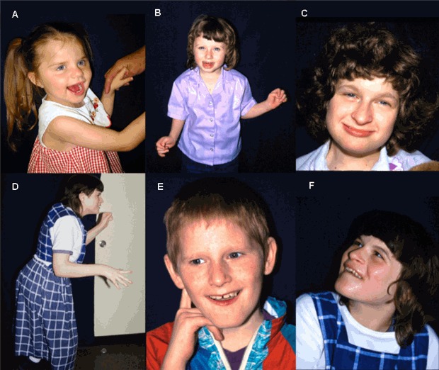 Figure 1. . Individuals depicted have a genetically confirmed diagnosis of Angelman syndrome.