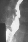 Figure 160-5. The characteristic “moth-eaten” appearance of the esophageal mucosa demonstrated on barium-swallow examination in a patient with esophageal candidiasis.