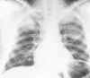 Figure 160-7. Multiple rounded pulmonary infiltrates compatible with invasive pulmonary aspergillosis.