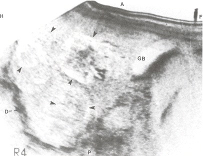 Figure 102.2. Longitudinal ultrasound scan of the liver obtained 4 cm to the right of the midline in a patient with metastases (arrowheads) from breast cancer.