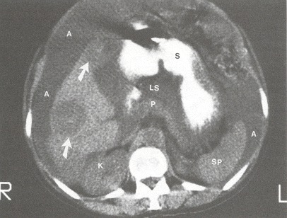 Figure 102.3. Nonenhanced CT scan of the upper abdomen in a patient with malignant ascites (A) and liver metastases (arrows) from colon cancer.