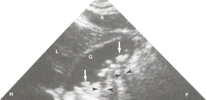 Figure 102.4. Longitudinal scan of the gallbladder (G) demonstrates multiple stones (arrows) that cast an acoustic shadow (arrowheads).