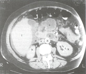Figure 102.6. CT scan of the upper abdomen demonstrates multiple pseudocysts (C) in this patient with pancreatitis.