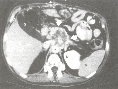 Figure 102.7. CT scan of the upper abdomen shows a large, predominately low-density pancreatic carcinoma (arrows).