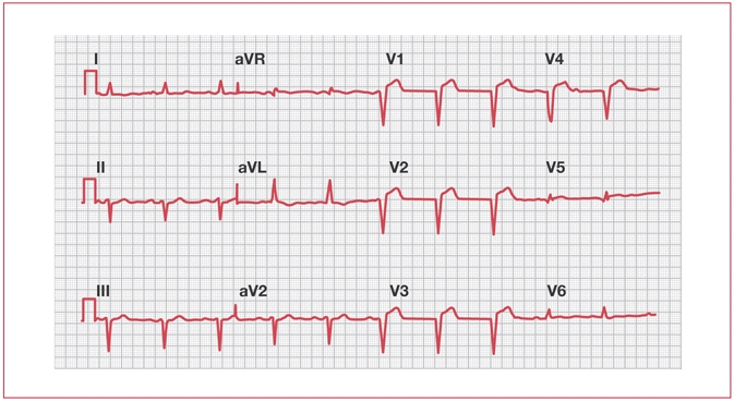 ECG demonstrating abnormal Q waves in V1–V4.