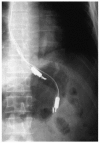 FIGURE 21.5. Abdominal x-ray showing the apparatus consisting of two nitric-oxide sensors, a 4-channel pH catheter, and a Tefion nasogastric tube.
