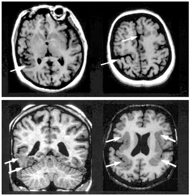 mri brain scan. MRI scan showing bilateral