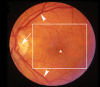 Figure 1. . Normal macula of an elderly patient.