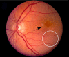 Figure 3. . Color fundus photograph derived from an individual with early, dry AMD.