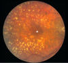 Figure 6. . Color fundus photograph from an individual with dry AMD, depicting the presence of numerous large (>125 micron diameter), calcified drusen deposited primarily within the peri- and parafoveal regions.