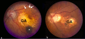 Figure 7. . Color fundus photograph from two patients (a and b) with macular geographic atrophy (GA).