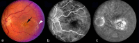 Figure 9. . Color fundus photograph (a), early fluorescein angiogram (b) and late fluorescein angiogram (c) from an individual with occult choroidal neovascularization.