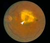 Figure 11. . Color fundus photograph from an individual with end stage (cicatricial) exudative AMD.