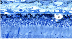 Figure 15. . Drusen (asterisks), form between the RPE and Bruch's membrane.