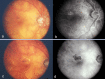 Figure 24. . a) New extrafoveal CNVM.