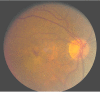 Figure 29. . Color photo of subfoveal CNVM adjacent to an area of geographic atrophy .