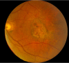 Figure 33. . Example of an eye which developed disciform scarring after PDT (photo from KMG files).