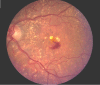 Figure 34. . Color photo of subfoveal CNVM and hemorrhage due to AMD (photo from KMG files).