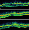 Figure 36. . a) Horizontal OCT scan throught the foveal region of subfoveal CNV seen in the photos above before anti-VEGF therapy.