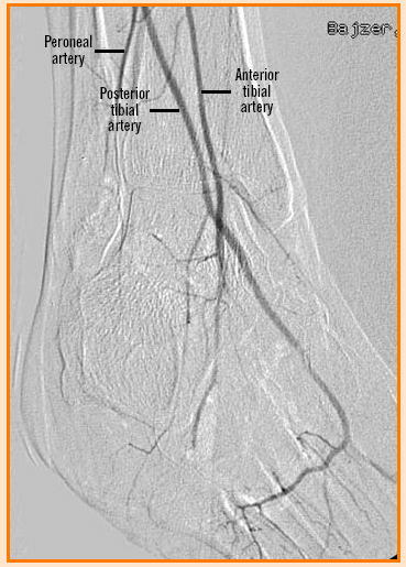 posterior tibial artery. The posterior tibial artery