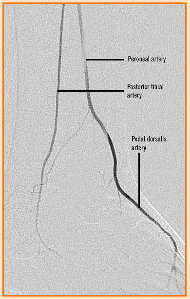 Thigh artery, lower leg artery, foot artery .
