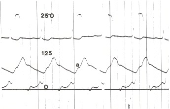 Figure 17.1. A simultaneous recording of left ventricular and aortic pressures in a patient with severe calcific aortic stenosis.