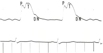 Figure 17.2. A carotid pulse tracing from a patient with severe aortic regurgitation.