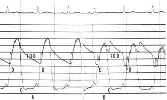 Figure 17.3. Panel A shows the simultaneous recording of the left ventricular and aortic pressures (on a scale of 0 to 200 mm Hg) in a patient with severe coronary artery disease.