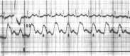 Figure 17.4. This aortic pressure tracing (scale of 0 to 100 mm Hg) was taken from a patient with a severe dilated idiopathic cardiomyopathy.