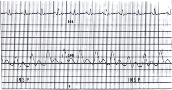 Figure 17.5. This aortic pressure pulse was recorded (scale of 0 to 200 mm Hg) in a patient with pericardial tamponade.