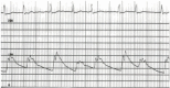 Figure 17.6. This aortic pressure pulse was recorded (scale of 0 to 200 mm Hg) in a patient with severe mitral regurgitation and atrial fibrillation.