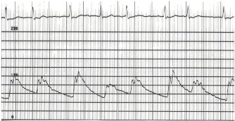 Figure 17.6. This aortic pressure pulse was recorded (scale of 0 to 200 mm Hg) in a patient with severe mitral regurgitation and atrial fibrillation.