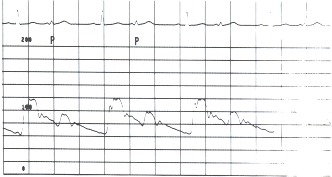 Figure 17.7. This aortic pressure tracing (scale of 0 to 200 mm Hg) was recorded in a patient who had coronary artery disease and a right coronary artery occlusion.