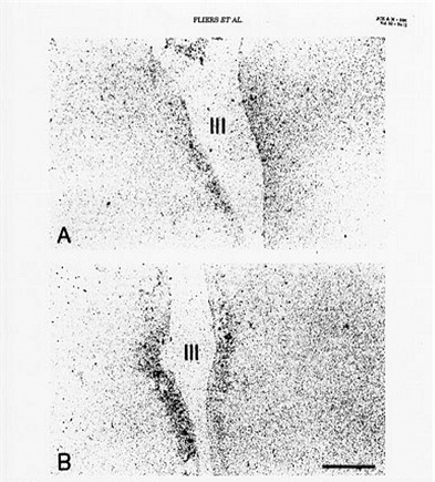 Figure 6. In situ hybridization study demonstrating mRNA for TRH in the periventricular nuclei of a subject who died with NTIS in Panel A, and a subject who died accidentally in Panel B. mRNA for TRH is significantly reduced in patients with NTIS. (Reference 90)