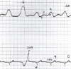 Figure 19.6. Right atrial pressure tracing and EGG showing cannon a wave (arrow) occurring simultaneously with a PVC.