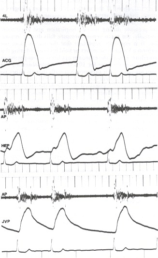 Figure 19.7. Apex cardiogram (ACG), hepatic pulsation (HEP), jugular venous pulse tracing (JVP), and phonocardiogram at the cardiac apex and fourth left interspaces (4L and AP) in a middle-aged woman with severe tricuspid regurgitation caused by mitral insufficiency.