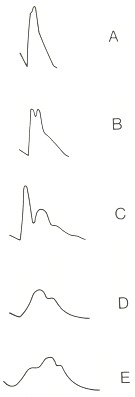 Figure 20.1. Carotid pulses: A, hyperkinetic pulse; B, bifid pulse; C, bifid pulse characteristic of IHSS; D, hypokinetic pulse; E, pulsus parvus et tardus.