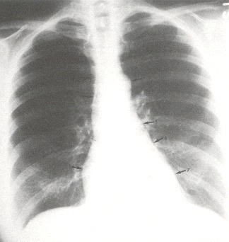 Figure 34.1. A normal PA chest x-ray.
