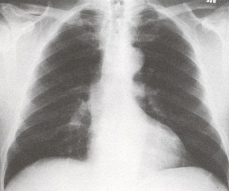 Figure 34.2. Left ventricular enlargement tends to round the left heart border as it enlarges laterally and downward.