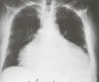 Figure 34.3. The classic "water bottle" heart is nonspecific for pericardial effusion and can be seen in cardiomyopathy.