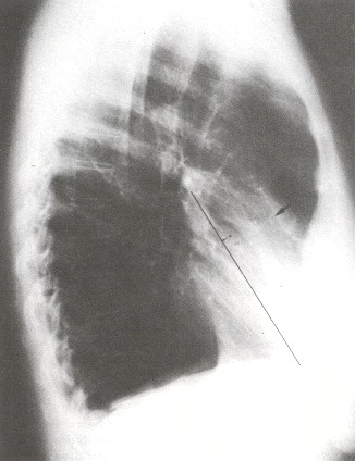 Figure 34.4. The standard lateral film is bordered by (1) the right ventricle and (2) the left ventricle.