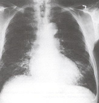 Figure 34.5. This radiograph represents florid interstitial pulmonary edema with numerous short parallel horizontal lines abutting the pleura in stepladder fashion, or Kerley B lines.