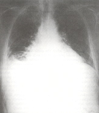 Figure 34.6. Extensive alveolar edema is present here with cardiomegaly, a right-sided pleural effusion, a visible horizontal fissure, bilateral perihilar haze, and alveolar infiltrate.