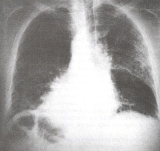 Figure 34.7. In this case of pulmonary edema, underlying pulmonary parenchymal disease (bullous emphysema) creates asymmetric infiltrates with a "Swiss cheese" or accentuated honeycombed pattern.