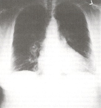 Figure 34.8. In this case, primary pulmonary hypertension has caused dramatically enlarged hilar vessels with "pruning" of distal vessels, creating a relative radiolucent appearance to the outer lung fields.