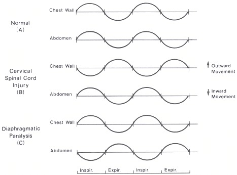 Figure 43.2. Chest wall and abdominal coordination during tidal breathing.