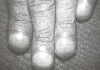 Figure 44.1. Clubbing of the fingers of one hand.