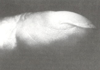 Figure 44.3. The clubbed fingertip in profile.