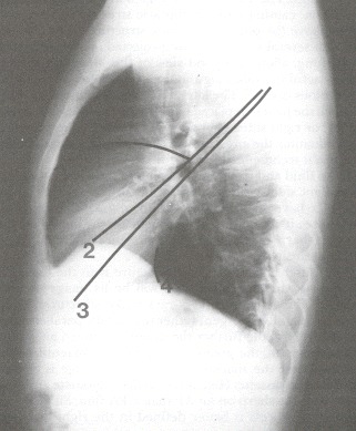 Figure 48.2. (1) Minor fissure.