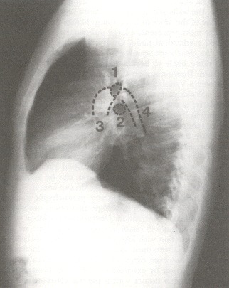 Figure 48.3. (1) Right upper lobe bronchial orifice.